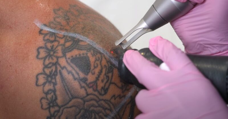 Importance of Professional Tattoo Removal