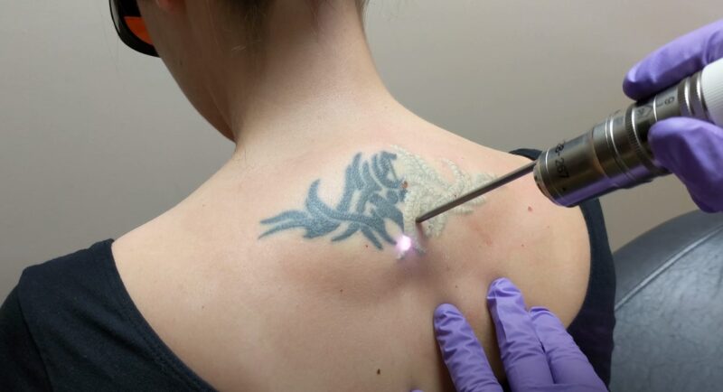 Tatoo Removal Is Laser Surgery the Best